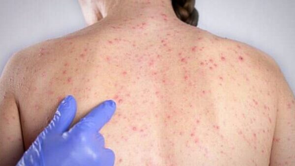 Costas de paciente com manchas de sarampo sendo examinadas por profissional de saúde